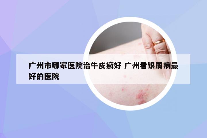 广州市哪家医院治牛皮癣好 广州看银屑病最好的医院