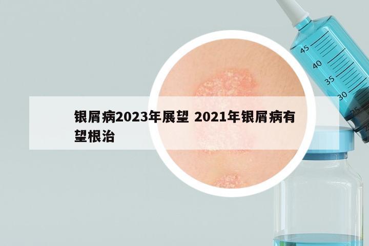 银屑病2023年展望 2021年银屑病有望根治