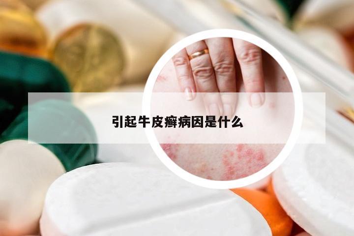 引起牛皮癣病因是什么