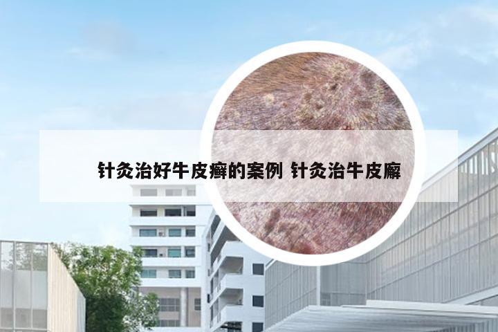 针灸治好牛皮癣的案例 针灸治牛皮廨