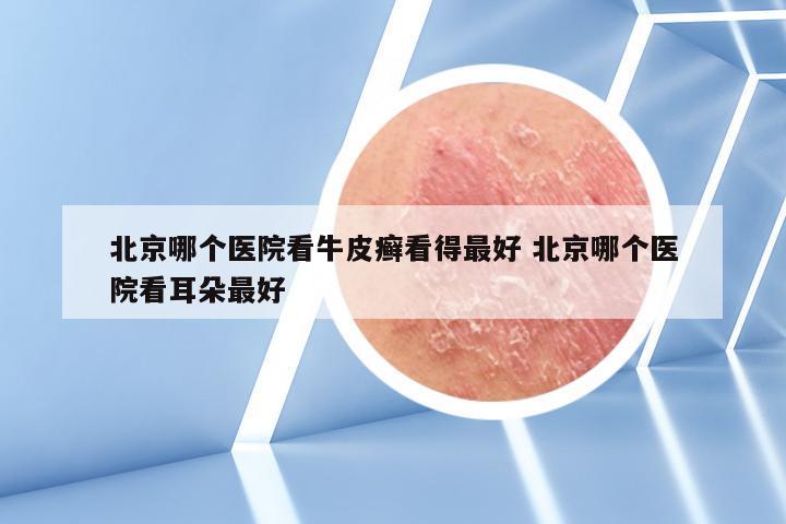北京哪个医院看牛皮癣看得最好 北京哪个医院看耳朵最好