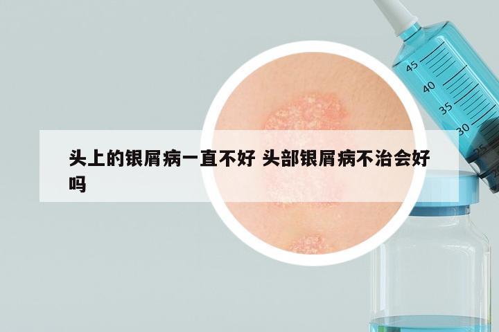 头上的银屑病一直不好 头部银屑病不治会好吗