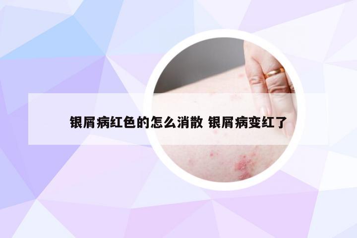 银屑病红色的怎么消散 银屑病变红了