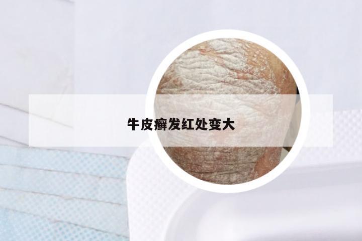 牛皮癣发红处变大
