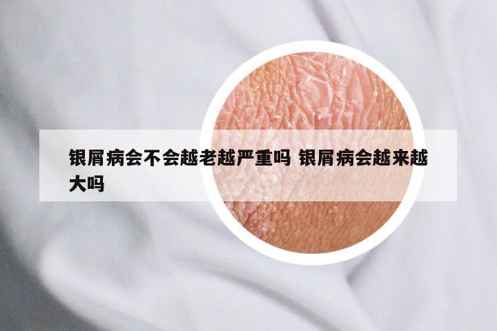 银屑病会不会越老越严重吗 银屑病会越来越大吗