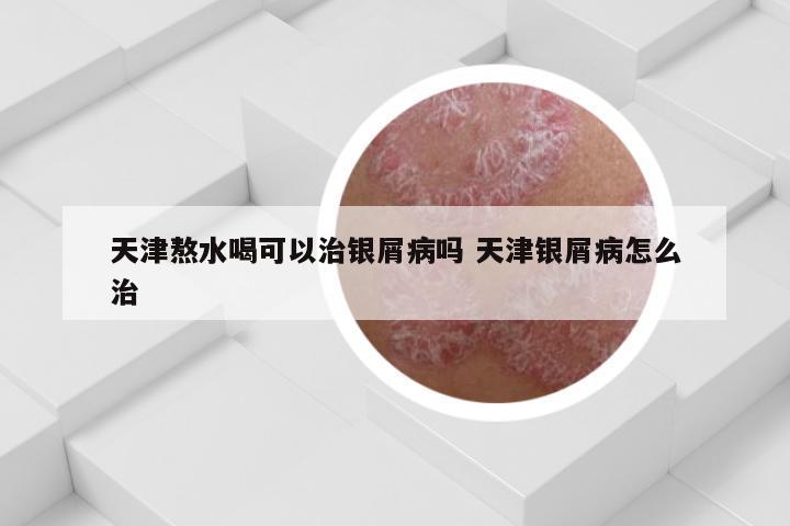 天津熬水喝可以治银屑病吗 天津银屑病怎么治