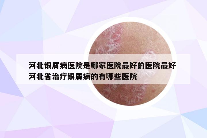 河北银屑病医院是哪家医院最好的医院最好 河北省治疗银屑病的有哪些医院