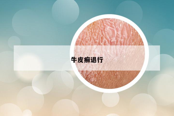 牛皮癣退行