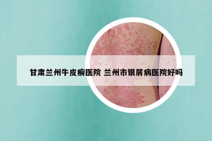 甘肃兰州牛皮癣医院 兰州市银屑病医院好吗