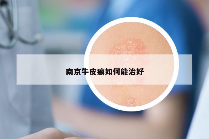 南京牛皮癣如何能治好