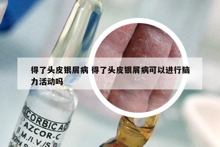 得了头皮银屑病 得了头皮银屑病可以进行脑力活动吗