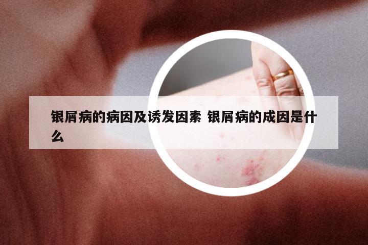 银屑病的病因及诱发因素 银屑病的成因是什么