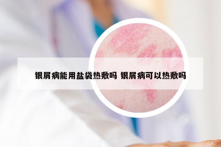 银屑病能用盐袋热敷吗 银屑病可以热敷吗