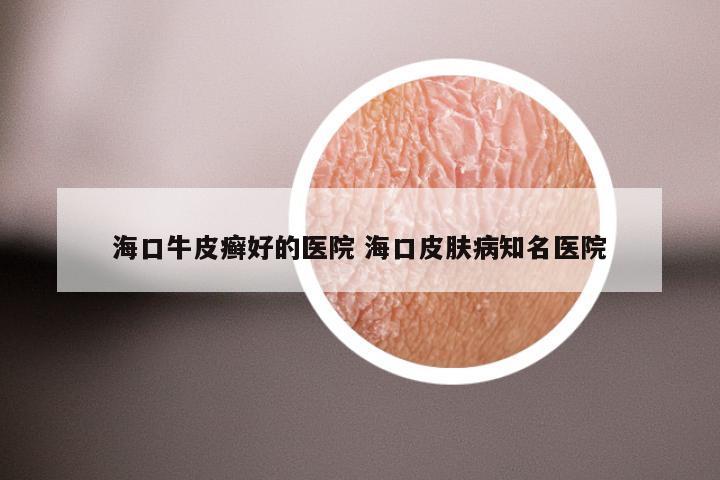 海口牛皮癣好的医院 海口皮肤病知名医院