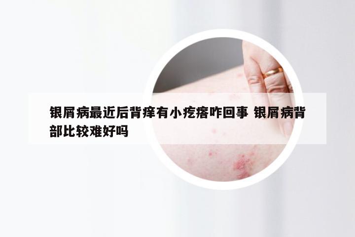 银屑病最近后背痒有小疙瘩咋回事 银屑病背部比较难好吗