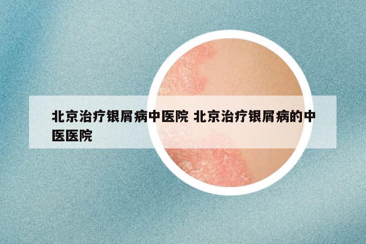 北京治疗银屑病中医院 北京治疗银屑病的中医医院