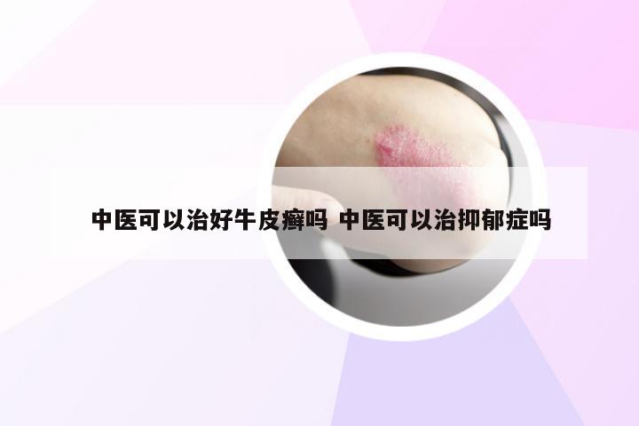 中医可以治好牛皮癣吗 中医可以治抑郁症吗