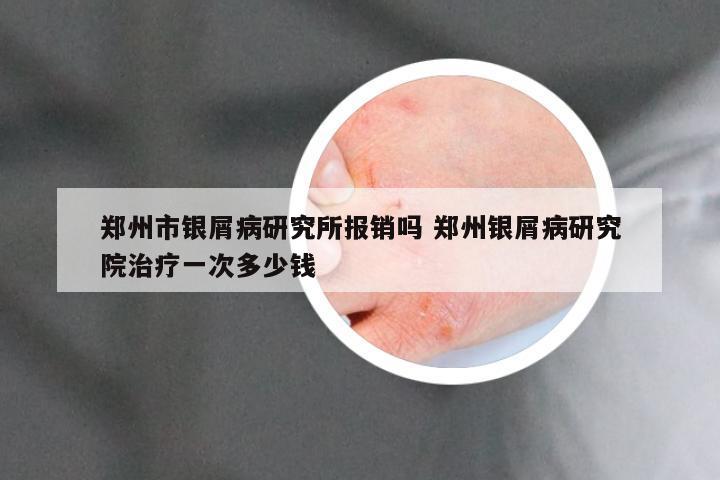 郑州市银屑病研究所报销吗 郑州银屑病研究院治疗一次多少钱