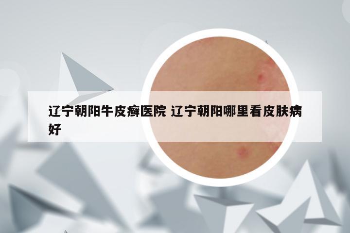 辽宁朝阳牛皮癣医院 辽宁朝阳哪里看皮肤病好