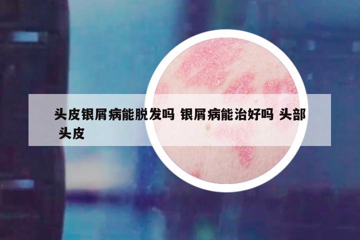 头皮银屑病能脱发吗 银屑病能治好吗 头部 头皮