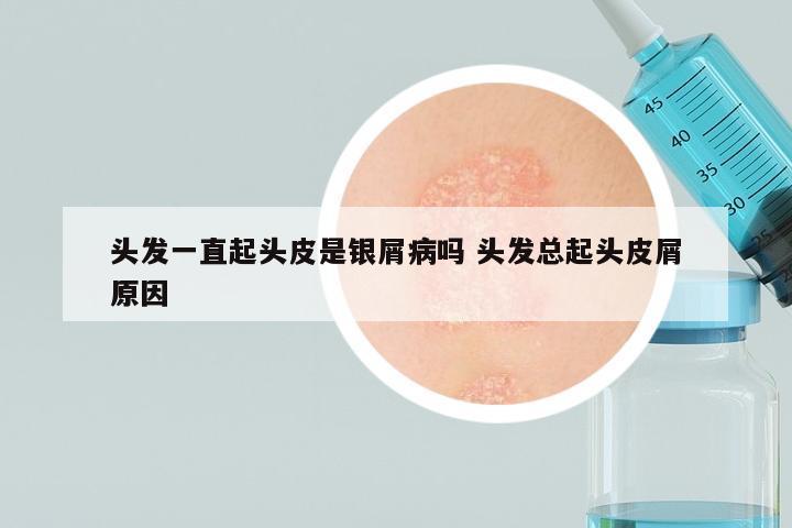 头发一直起头皮是银屑病吗 头发总起头皮屑原因