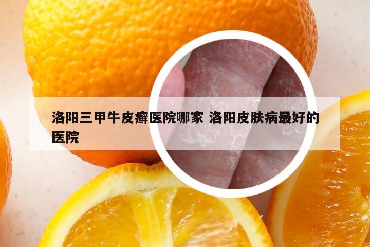 洛阳三甲牛皮癣医院哪家 洛阳皮肤病最好的医院