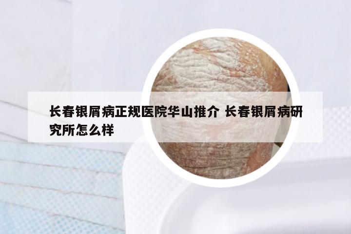 长春银屑病正规医院华山推介 长春银屑病研究所怎么样