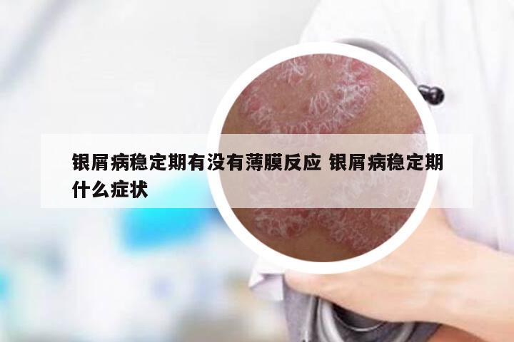 银屑病稳定期有没有薄膜反应 银屑病稳定期什么症状