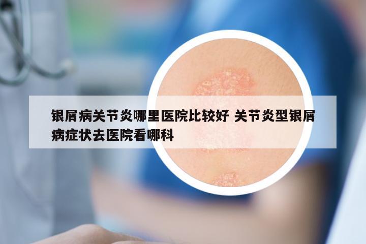 银屑病关节炎哪里医院比较好 关节炎型银屑病症状去医院看哪科
