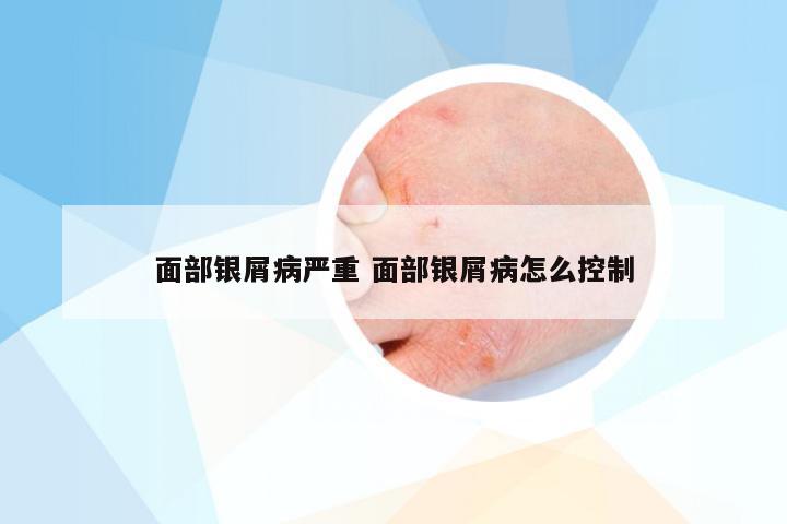 面部银屑病严重 面部银屑病怎么控制