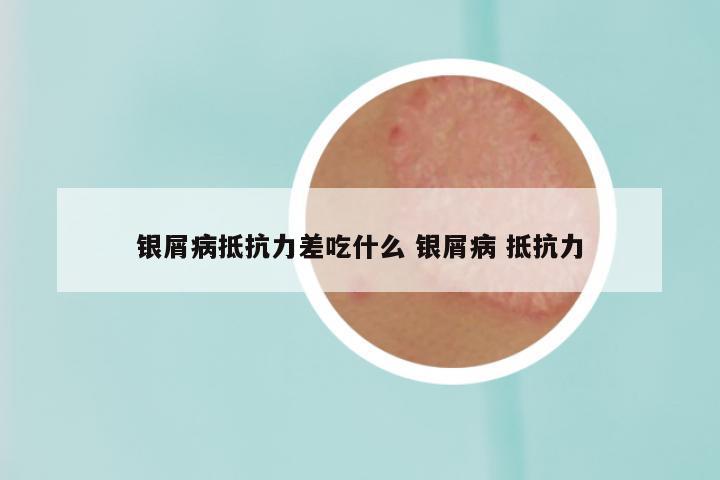 银屑病抵抗力差吃什么 银屑病 抵抗力