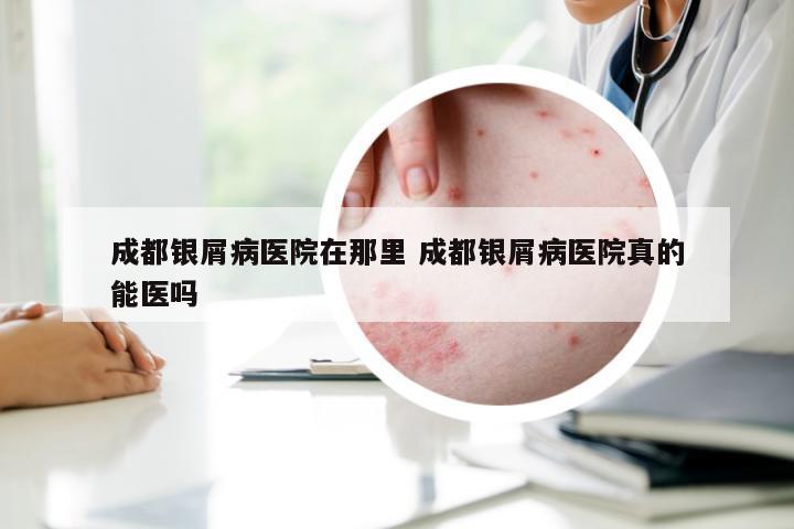 成都银屑病医院在那里 成都银屑病医院真的能医吗