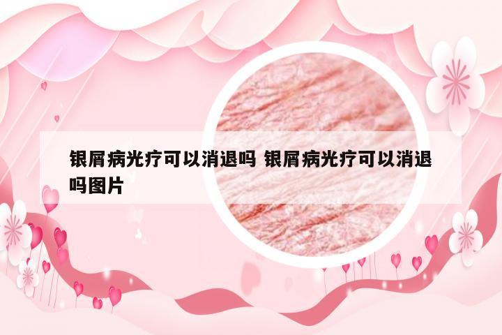 银屑病光疗可以消退吗 银屑病光疗可以消退吗图片