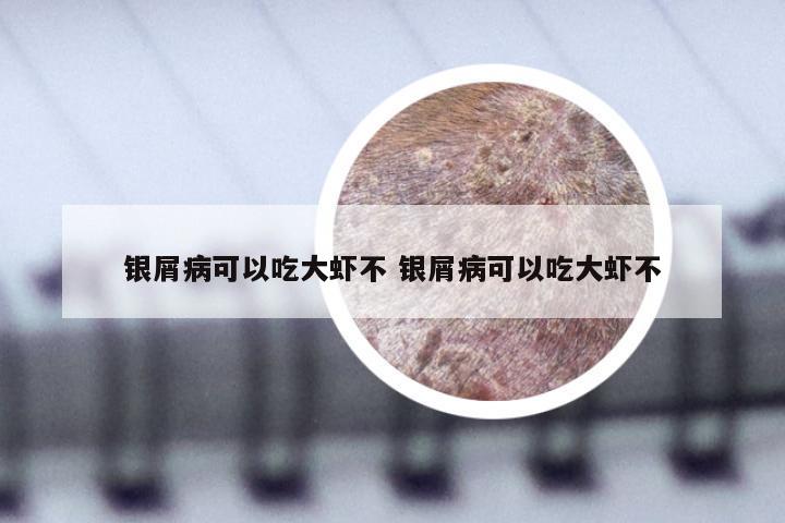 银屑病可以吃大虾不 银屑病可以吃大虾不