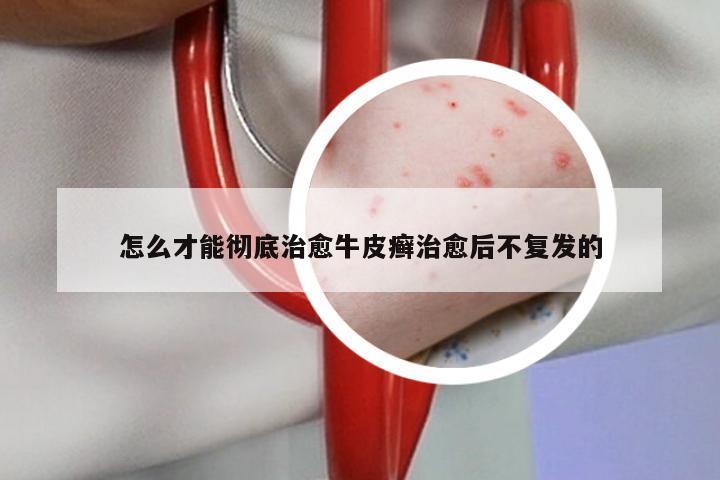 怎么才能彻底治愈牛皮癣治愈后不复发的