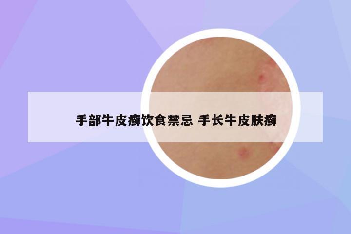 手部牛皮癣饮食禁忌 手长牛皮肤癣