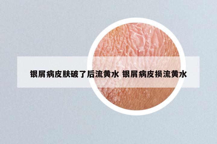 银屑病皮肤破了后流黄水 银屑病皮损流黄水