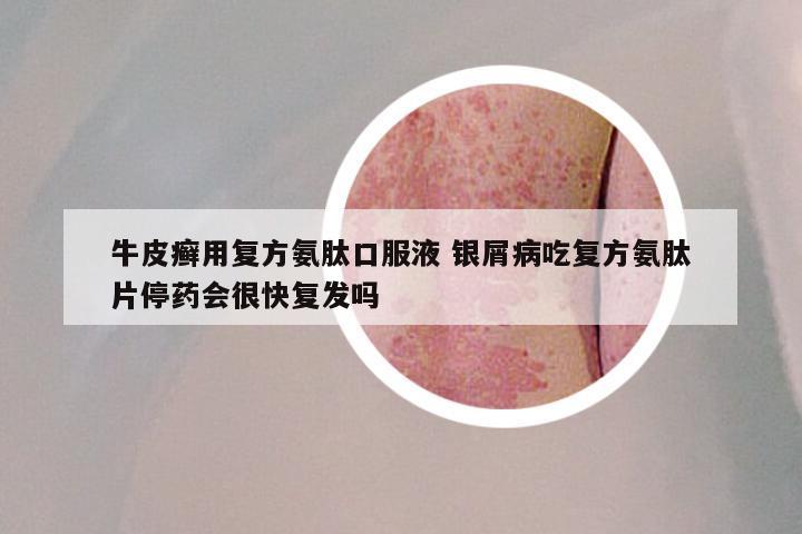 牛皮癣用复方氨肽口服液 银屑病吃复方氨肽片停药会很快复发吗