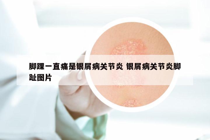 脚踝一直痛是银屑病关节炎 银屑病关节炎脚趾图片