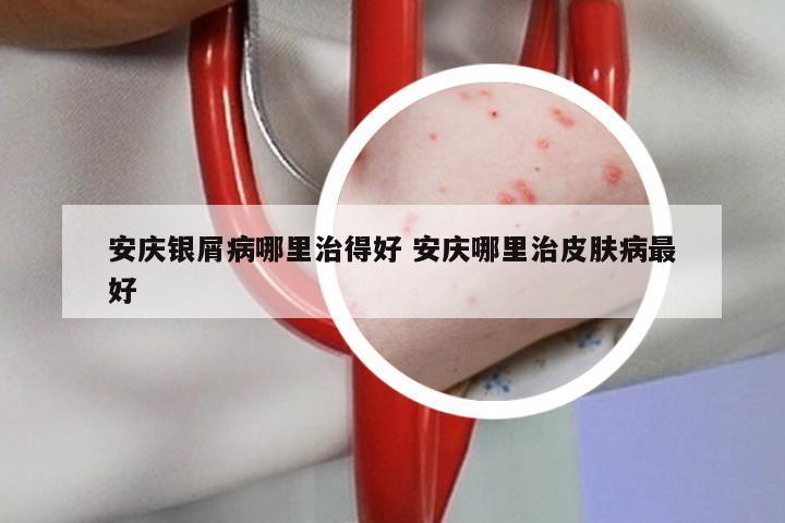 安庆银屑病哪里治得好 安庆哪里治皮肤病最好