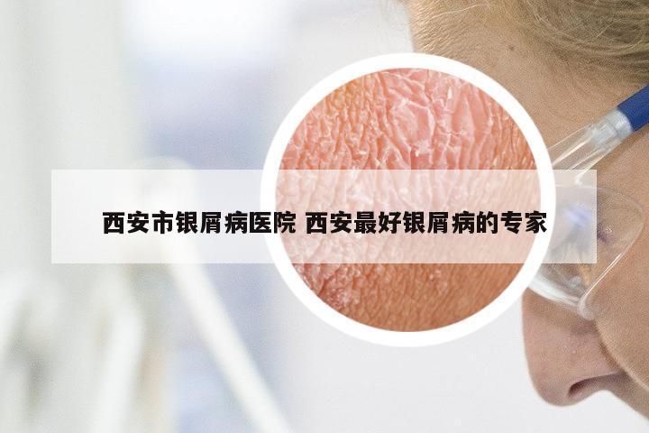 西安市银屑病医院 西安最好银屑病的专家