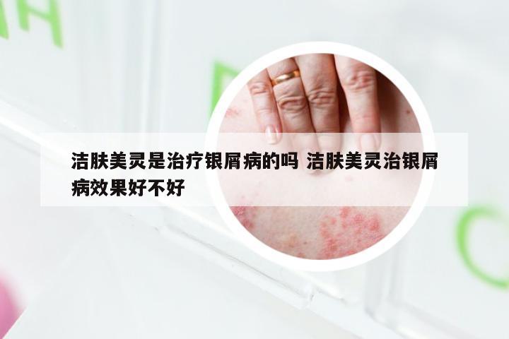 洁肤美灵是治疗银屑病的吗 洁肤美灵治银屑病效果好不好