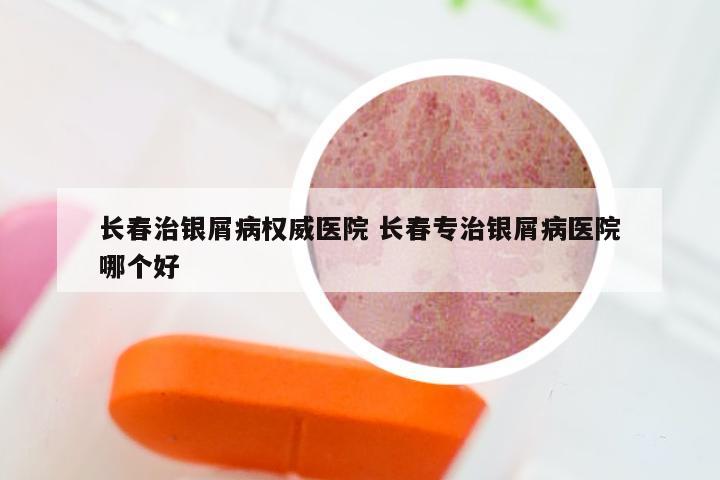 长春治银屑病权威医院 长春专治银屑病医院哪个好