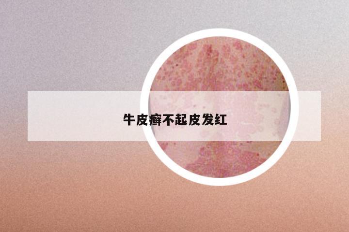 牛皮癣不起皮发红