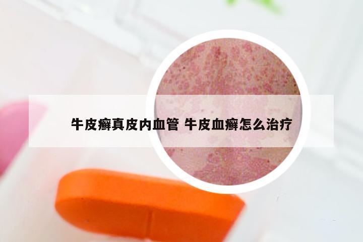 牛皮癣真皮内血管 牛皮血癣怎么治疗