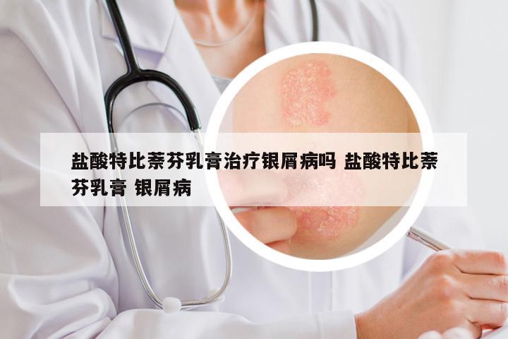 盐酸特比萘芬乳膏治疗银屑病吗 盐酸特比萘芬乳膏 银屑病