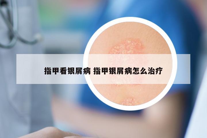 指甲看银屑病 指甲银屑病怎么治疗