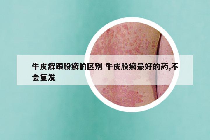 牛皮癣跟股癣的区别 牛皮股癣最好的药,不会复发