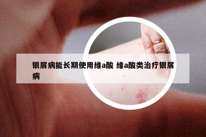 银屑病能长期使用维a酸 维a酸类治疗银屑病
