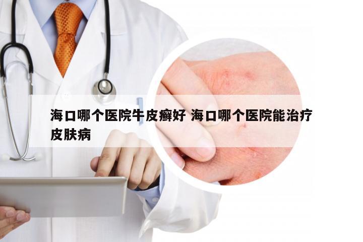 海口哪个医院牛皮癣好 海口哪个医院能治疗皮肤病